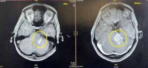 Acoustic neuroma - انواع الاورام الدماغية - الدكتور فراس شعبان