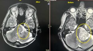 Acoustic neuroma - انواع الاورام الدماغية - د. فراس شعبان