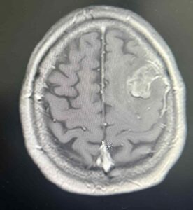 الأورام الدبقية Gliomas - انواع الاورام الدماغية - الدكتور فراس شعبان