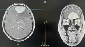 الأورام السحائية Meningiomas - انواع الاورام الدماغية - جراح الدماغ والاعصاب د. فراس شعبان