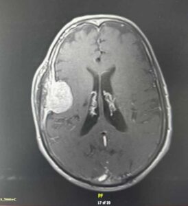 الأورام السحائية Meningiomas - انواع الاورام الدماغية  - د. فراس شعبان