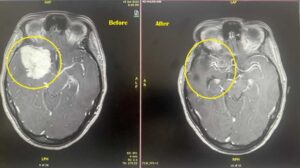 الأورام السحائية Meningiomas - انواع الاورام الدماغية - الدكتور فراس شعبان