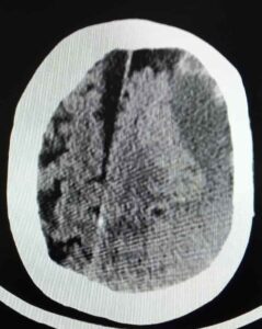 النزيف تحت الجافية Subdural Hemorrhage - النزيف الدماغي