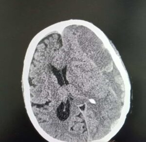 النزيف تحت الجافية Subdural Hemorrhage - انواع النزيف الدماغي