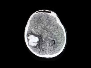 النزيف داخل المخ Intracerebral Hemorrhage - انواع النزيف الدماغي