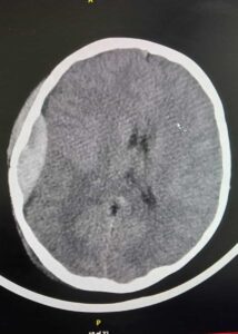 النزيف فوق الجافية Epidural Hemorrhage - انواع النزيف الدماغي