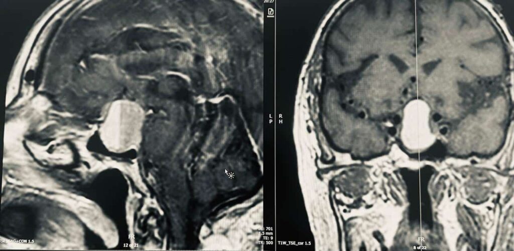 Pituitary apoplexy - أعراض ورم الغدة النخامية