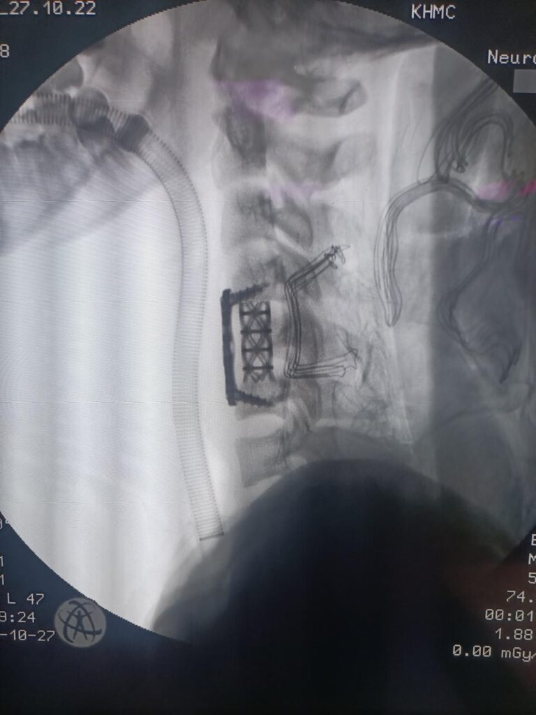 عملية استئصال فقرة عنقية مكسورة (الفقرة العنقية الخامسة) واستبدالها بشبكة وصفيحة للتثبيت وتحرير النخاع الشوكي